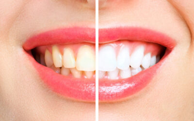 Teeth Whitening: Revitalizing Your Smile with a Brighter Appearance