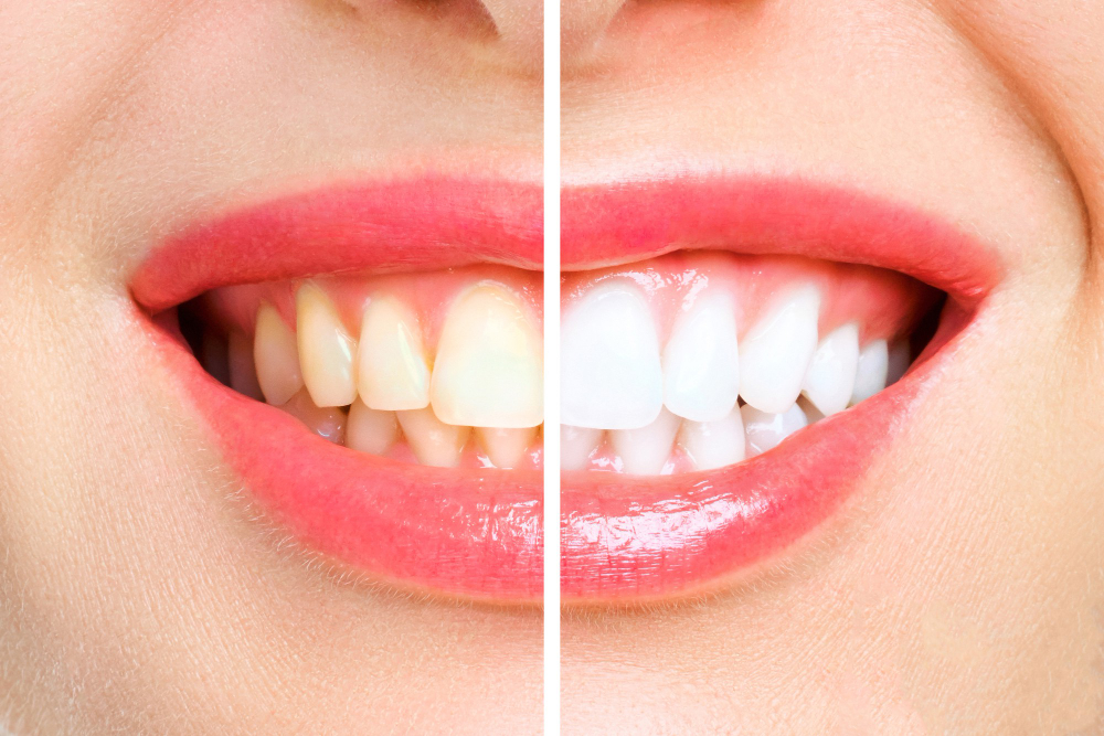 Teeth Whitening: Revitalizing Your Smile with a Brighter Appearance